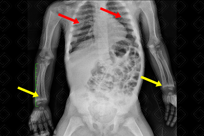 Radiografia de tórax evidenciando presença de rosário raquítico ( setas vermelhas) e aspecto franjeado nas metáfises distais dos rádios e ulnas, bilateralmente (setas amarelas).