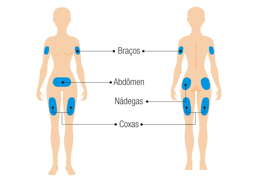 Locais de aplicação de insulina