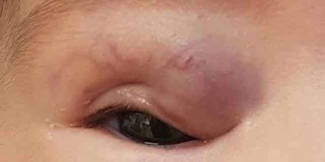 hemangioma capilar palpebral e