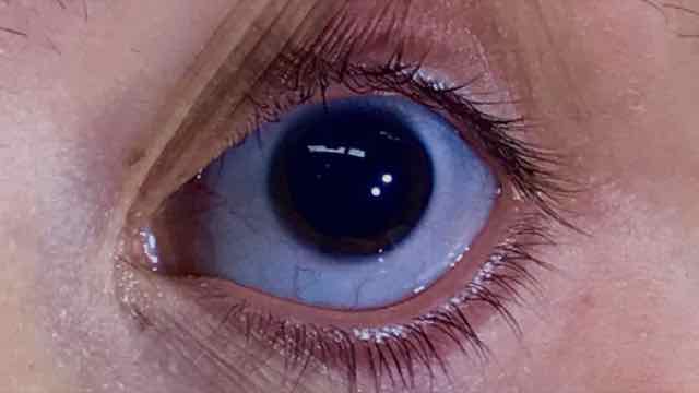 As veias reduzir oculares como