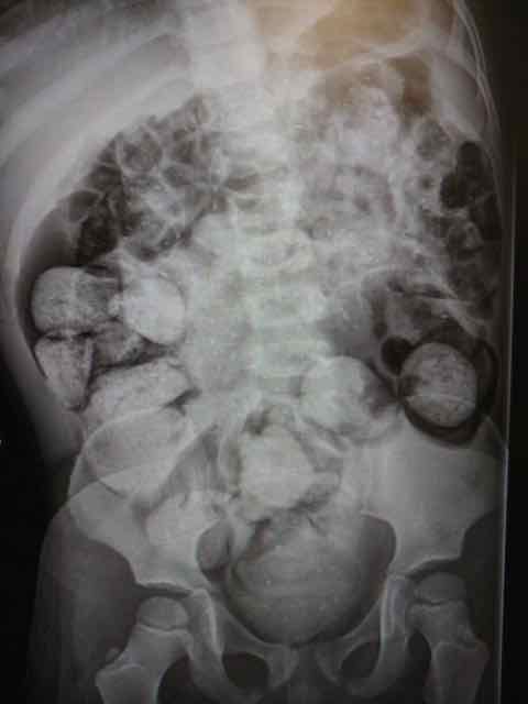 Qual exame que detecta anemia