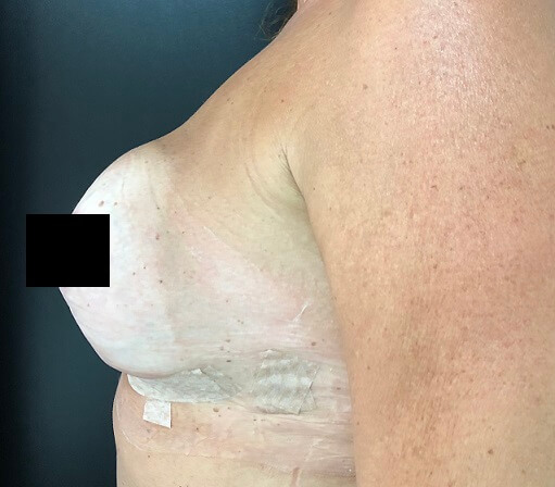 implantes mamários