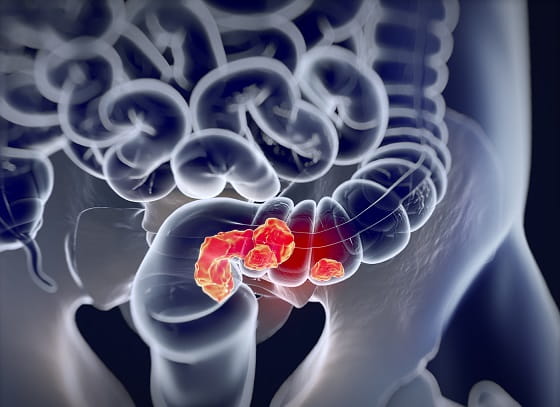cancer no intestino quanto tempo de vida