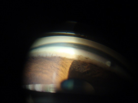 Gonioscopia