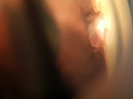 Gonioscopia