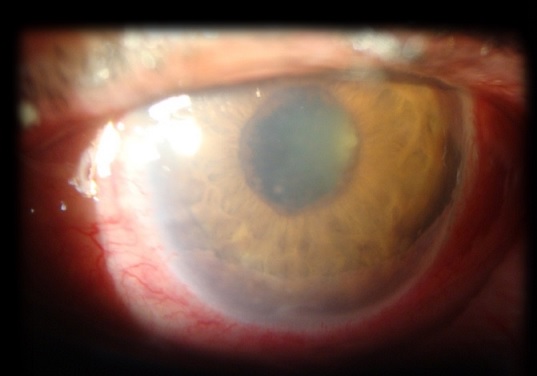 Hiperemia Acentuada