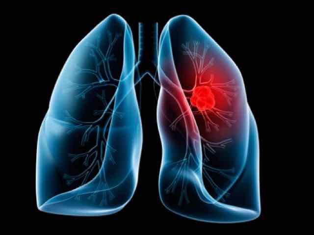 Tromboembolismo pulmonar manifestaciones clinicas
