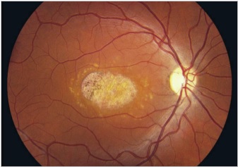 retina