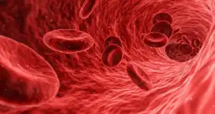 hemoglobinúria paroxísticanoturna