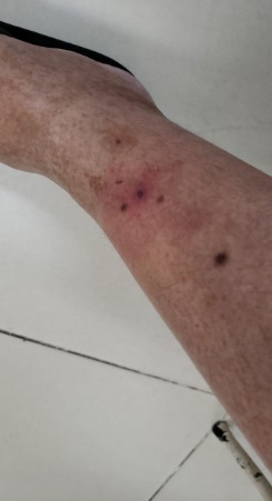 Irradiando dor nas pernas dos quadris