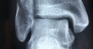 entorse de tornozelo