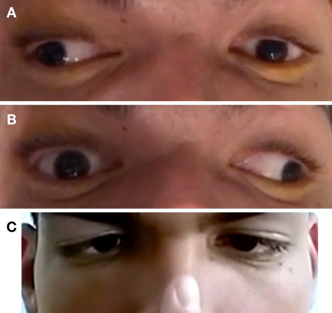Oftalmoparesia-internuclear-bilateral-secundária-a-esclerose-múltipla-relato-de-caso
