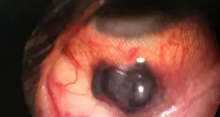 melanoma de corpo ciliar