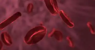 anemia aplásica