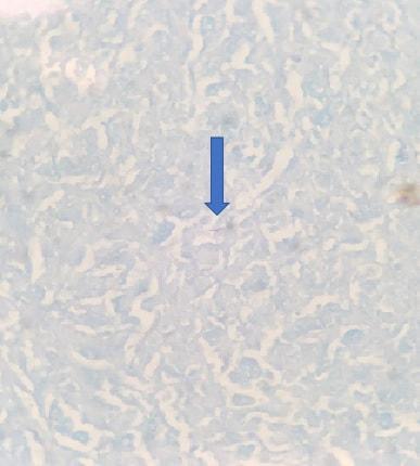 tuberculose