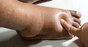 Pé de Charcot
