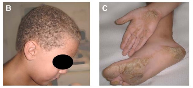 Cardiomiopatia Arritmogênica