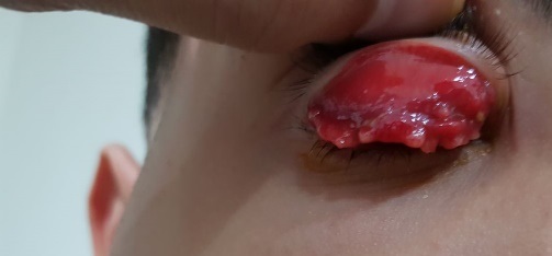 síndrome oculoglandular de Parinaud