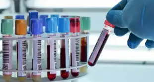 mão de laboratorista colocando tubo de sangue com hemólise para centrifugação