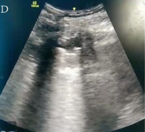 Ultrassom pulmonar de paciente com coronavírus D: consolidação translobar