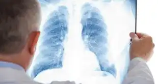 Médico analisa raio-x de pulmão de paciente com suspeita de tuberculose. Doença que o Brasil reduziu em 8% o número de óbitos na última década.