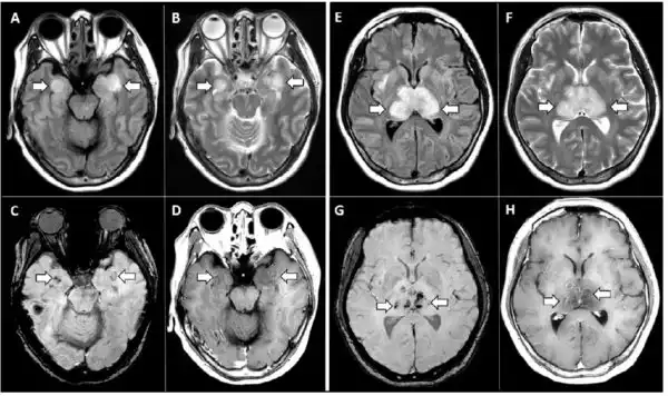 Ressonância magnética de paciente diagnosticado com Covid-19
