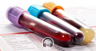 frascos de sangue de paciente com covid-19