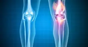 Paciente com osteoartrite de joelhos e quadril faz tratamento para bloqueio da interleucina 1-beta