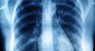 O pneumotórax, com elevada incidência na população, tem como quesito de maior relevância no seu manejo a prevenção de recorrências.