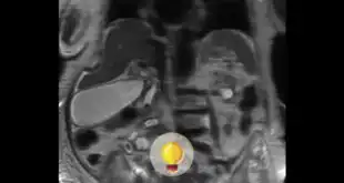 Colangioressonância magnética de paciente idosa