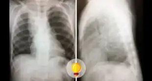 imagem de radiografia de tórax