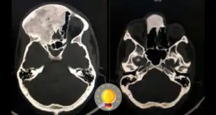 quiz displasia fibrosa
