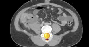 Paciente 33 anos, sexo masculino, quadro de dor abdominal na fossa ilíaca direita. O que será? Teste seus conhecimentos com o Quiz PEBMED!