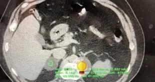 Qual o diagnóstico dessa tomografia de abdome? Teste conhecimento com o Quiz PEBMED
