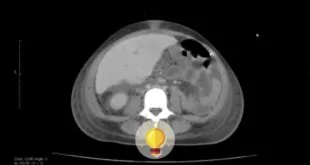 imagem de paciente com covid-19 e dor abdominal