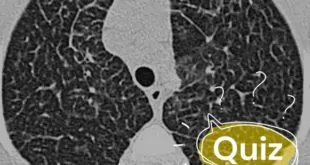 quiz quadro pulmonar com piora evolutiva
