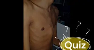 quiz abaulamento