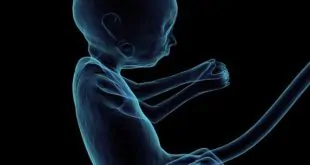 Oclusão endoscópica traqueal fetal