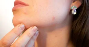 MELASMA: OPÇÕES TERAPÊUTICAS E DESAFIOS