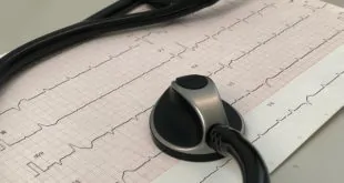 Quando iniciar anticoagulação após AVC relacionado a fibrilação atrial