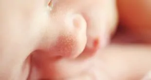 Terapia com surfactante minimamente invasivo não reduz a incidência de óbito ou broncodisplasia entre prematuros com SDR