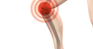 Aumento do número de casos de osteoartrite está tornando-se uma preocupação mundial