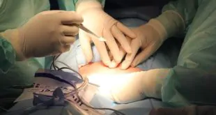 Câncer de colo uterino existe diferença na recuperação de histerectomia radical aberta ou videolaparoscópica