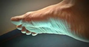 Pacientes com 70 anos ou mais se beneficiam da cirurgia de hálux valgo