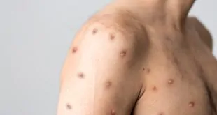 monkeypox