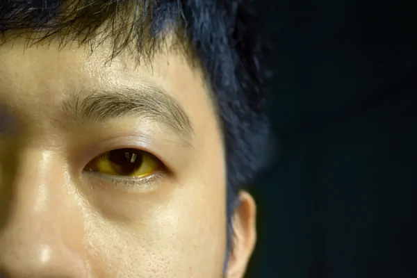 Close de homem oriental com olhos amarelados indicando insuficiência hepática aguda